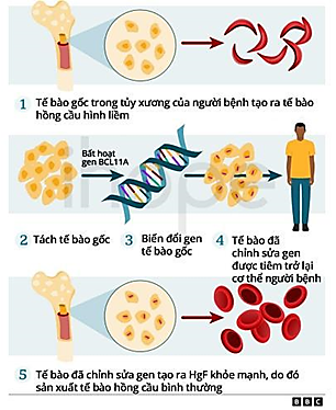 Liệu pháp Casgevy trong điều trị bệnh hồng cầu hình liềm là một phương pháp biến đổi gene tế bào gốc của chính bệnh nhân. Các nhà khoa học thu thập tế bào gốc từ tủy xương, sau đó sử dụng công cụ CRISPR-Cas9 (ảnh 1)
