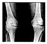 Ảnh chụp xương khớp gối của một người bệnh như hình bên. Trong kỹ thuật chụp ảnh này loại tia nào đã được sử dụng? (ảnh 1)