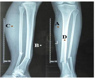 Khi sử dụng tia X để chụp ảnh xương ống chân bị gãy của một bệnh nhân thì thu được trên ảnh các vùng sáng, (ảnh 1)