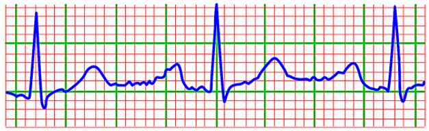 Điện tâm đồ là đồ thị ghi những thay đổi của dòng điện trong tim. (ảnh 1)